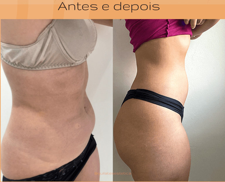 Lipo sem Corte (Lipo Enzimática)