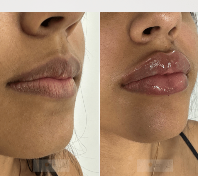 Preenchimento Facial e Corporal em Florianópolis